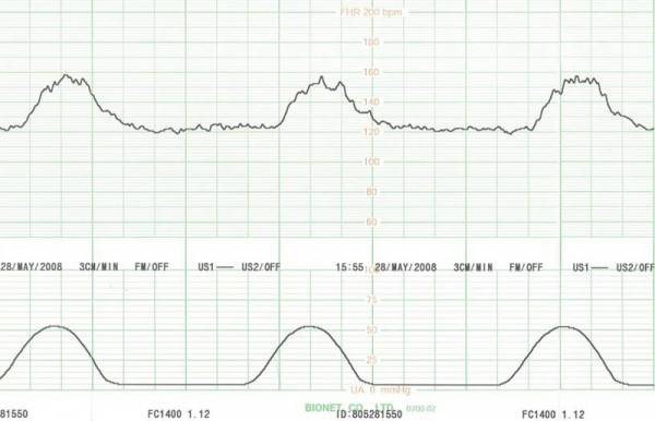 Καρδιοτοκογράφος Smart 3 - Image 5