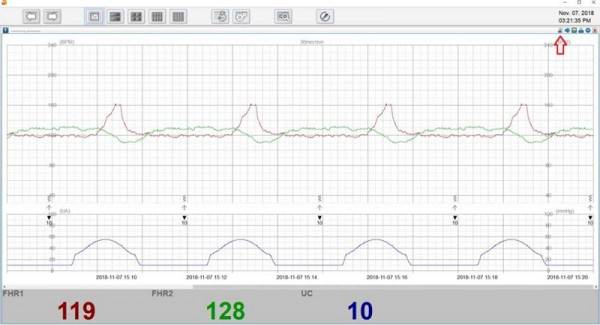 Καρδιοτοκογράφος Smart 3 - Image 8